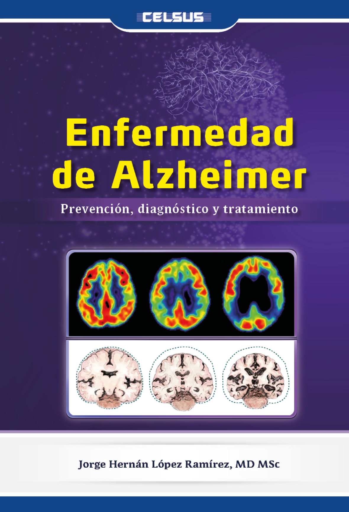 Enfermedad de Alzheimer: prevención, diagnóstico y tratamiento