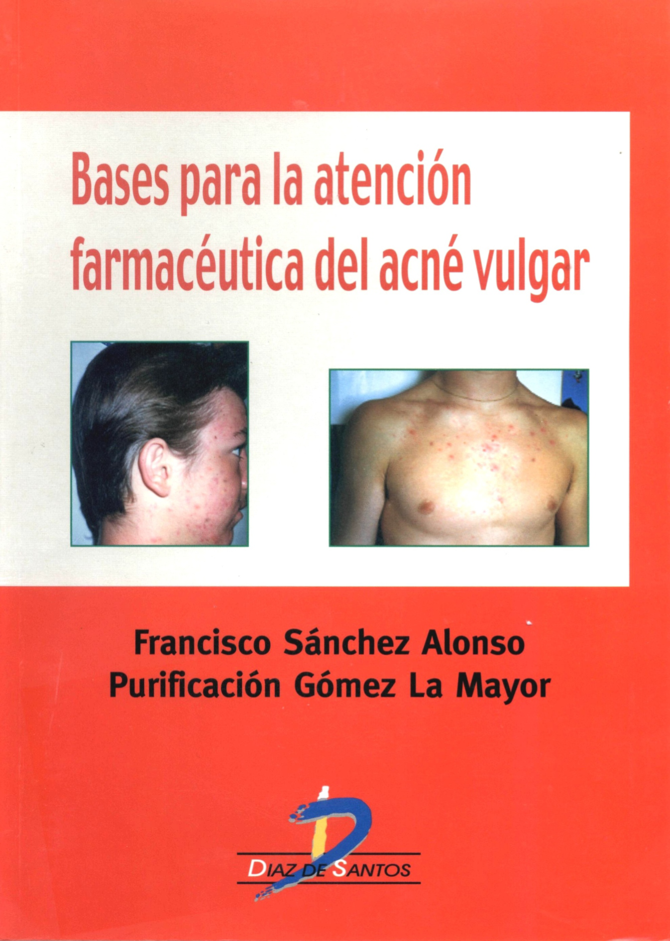Bases para la atención farmacéutica del acné vulgar