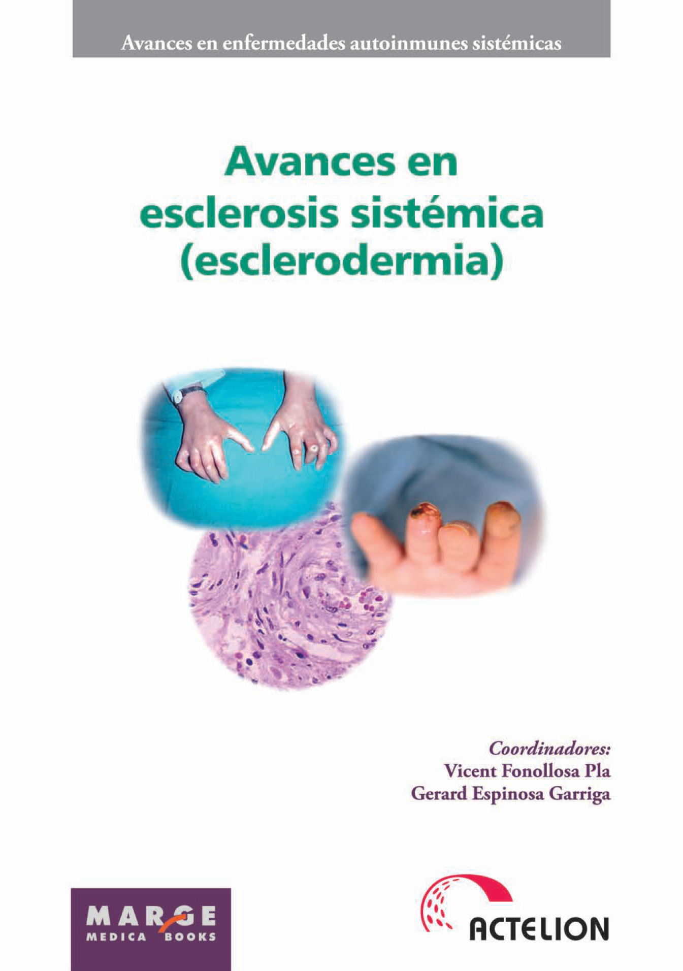 Avances en esclerosis sistémica (esclerodermia)